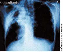 Aspergilloma, or Fungus Ball