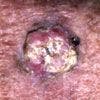 Keratoacanthoma Resembling Squamous Cell Carcinoma