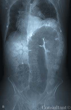 Fournier Gangrene in a 70-Year-Old Man