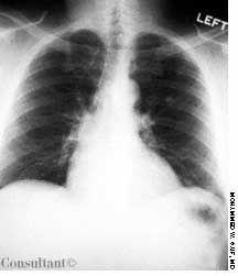 Bronchial Carcinoid Tumor