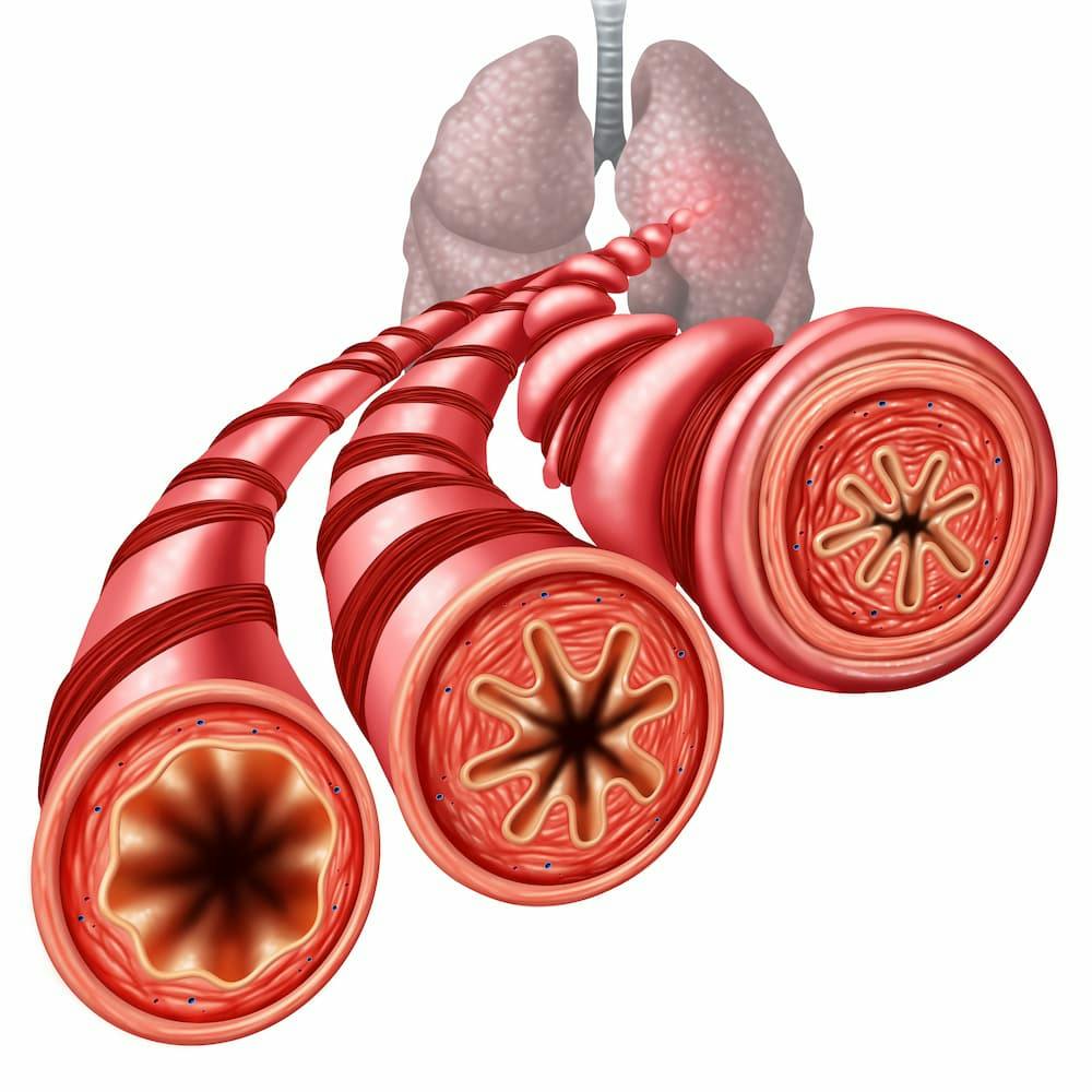 Review of Biologic Treatments for Asthma Finds Inconsistent Effects on Airway Hyperresponsiveness