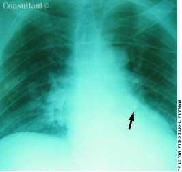 Foreign Body in the Lung