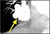 Pulmonary Arteriovenous Malformation in a Woman With Severe Mitral Valve Stenosis