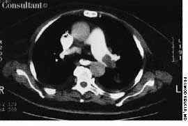 Pulmonary Embolism With Pulmonary Infarction