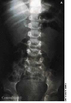 Intussusception: A Primary Care Primer