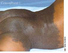 Congenital Melanocytic Nevus in Infant’s Diaper Area