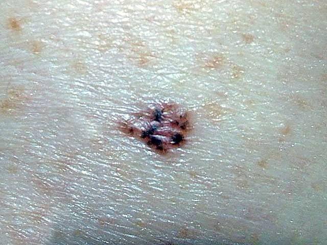 Nodule With Dark Black Pigmentation: Your Dx?