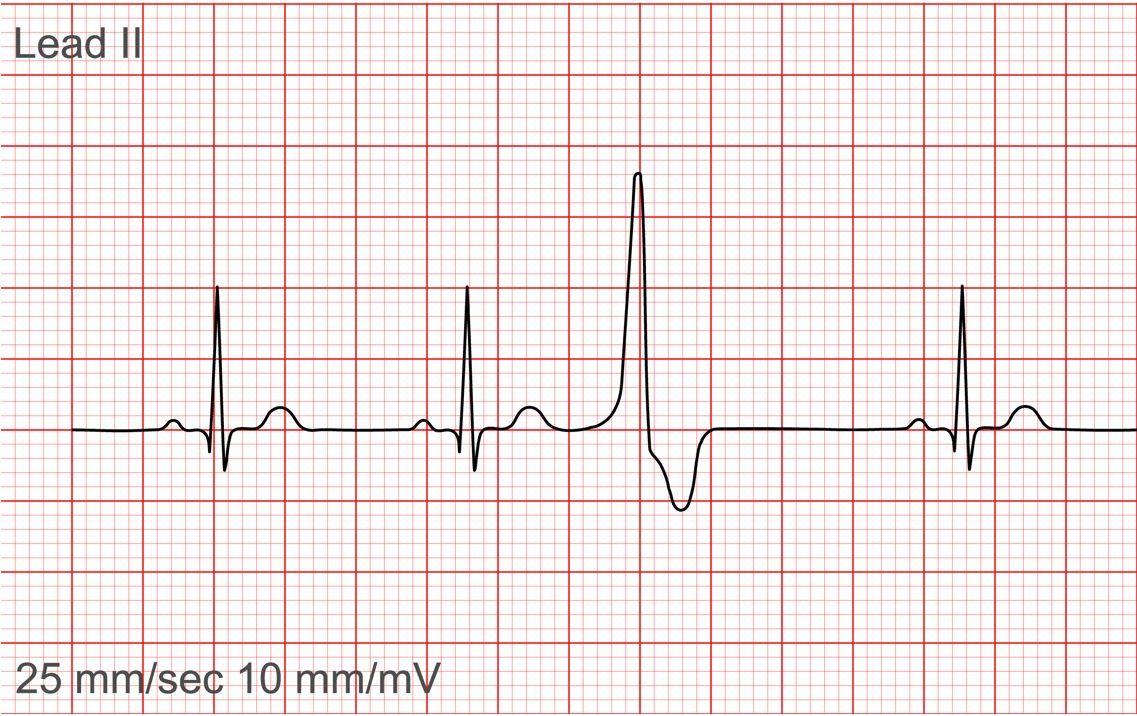 Coffee Had Negligible Effect on Atrial Arrhythmias but Was Linked to PVCs, Study Finds 