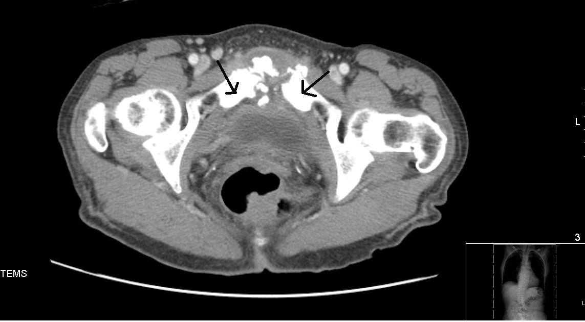 Osteomyelitis in a 75-Year-Old Heroin User 