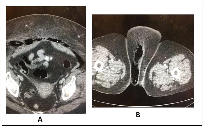 Fournier's gangrene, necrotizing soft tissue infection 