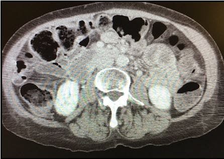 Chronic pancreatitis 