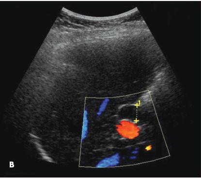 Gallbladder Agenesis