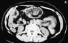 Colocolic Intussusception