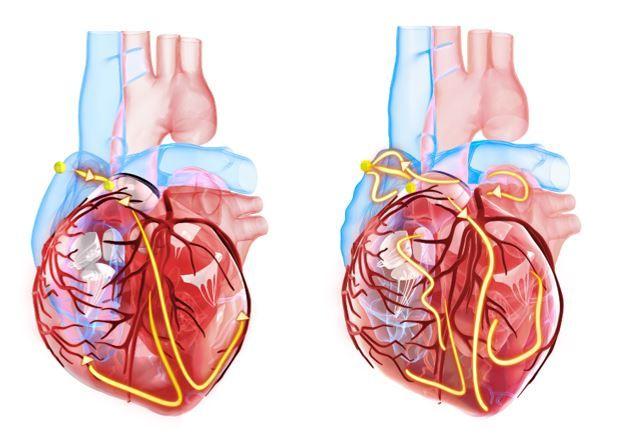 Worldwide Burden of Atrial Fibrillation More Than Doubled Over 30 Years: Global Analysis / image credit ©TuMeggy/stock.adobe.com