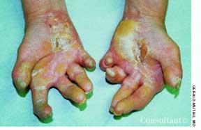 Epidermolysis Bullosa