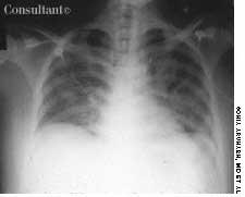 Pneumocystis Carinii Pneumonia