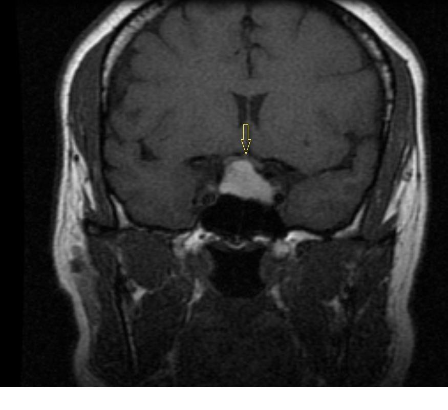 Hemorrhagic pituitary macroadema.