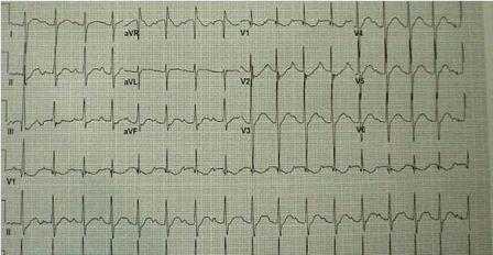 Generalized Weakness After Heavy Drinking: Your Dx?