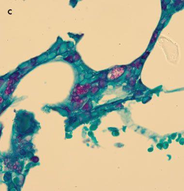 Disseminated Histoplasmosis