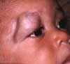 Deep (Cavernous) Hemangioma