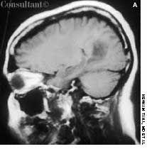 Astrocytoma in Pregnancy