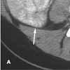 Appendicitis With Bowel Malrotation