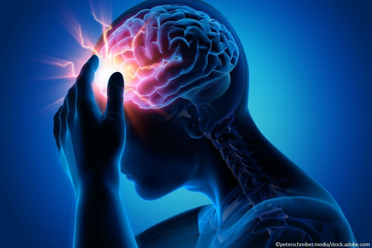 Axsome Therapeutics: FDA Accepts NDA Resubmission for AXS-07 for Acute Treatment of Migraine / image credit migraine concept  ©peter schrieber/stock.adobe.com