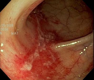 Crampy Abdominal Pain: Your Impression?