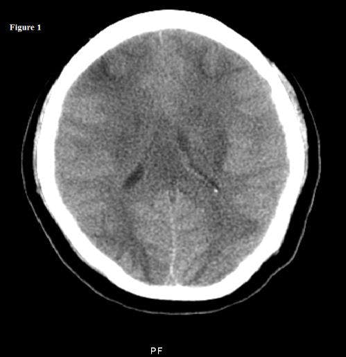 Reversible Coma in a Young Postpartum Woman 