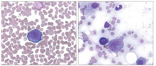 Unsuspected Parvovirus B19 Infection in a Person With AIDS