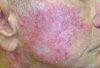 Actinic Keratoses