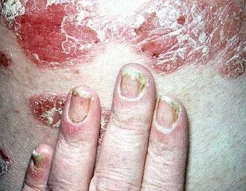 nail psoriasis