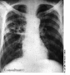 Cystic Bronchiectasis