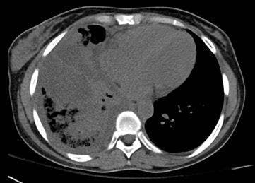 In Sickle Cell Disease, What Cause of Acute Respiratory Symptoms? 