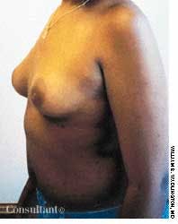 Gynecomastia