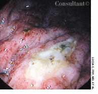 Maltoma in a 72-year-old Man 