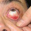 Conjunctival Granuloma