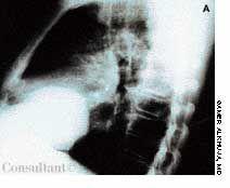 Localized Eventration of Right Hemidiaphragm