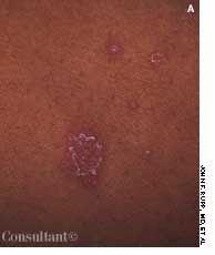 Pityriasis Rosea or Ringworm?