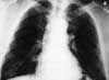 Unusual Presentation of Pneumocystis carinii Pneumonia