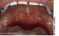 Palatal Petechiae