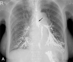 Esophageal Carcinoma With Tracheoesophageal Fistula