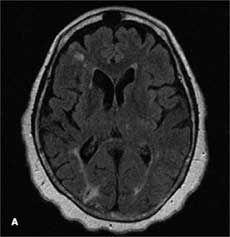 Aortic Atheroma