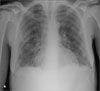 Serratia marcescens Pneumonia in an HIV-Infected Patient