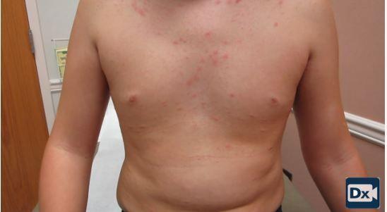 Teen Boy with a Progressive Pruritic Rash 