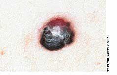 Thrombosed Cherry Hemangioma