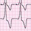 Right Bundle-Branch Block After Pacemaker Implantation