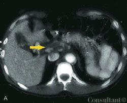 Portal Vein Thrombosis