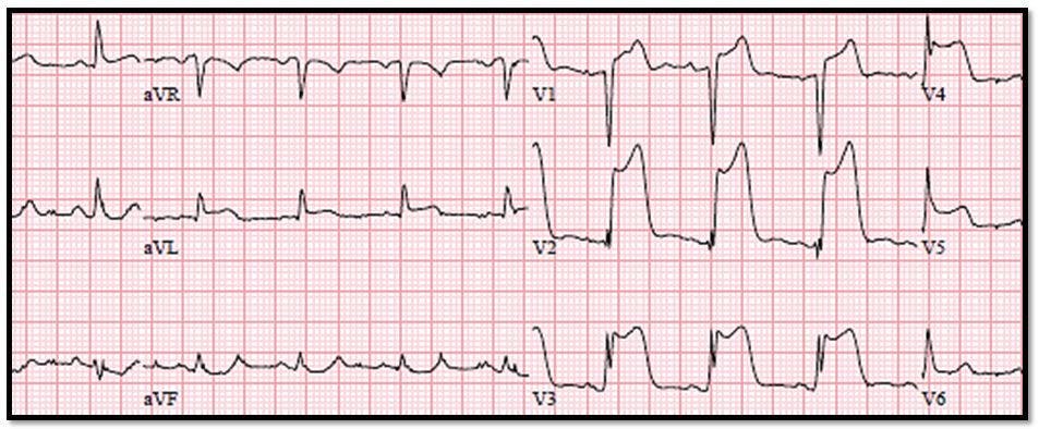 Serial EKGs, STEMI, ACS, acute coronary syndrome