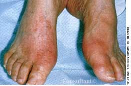 Acute Gouty Arthritis in a 56-Year-Old Man